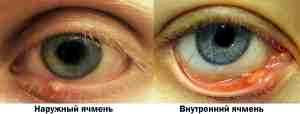 Левомицетин глазные капли и альбуцид ячмень