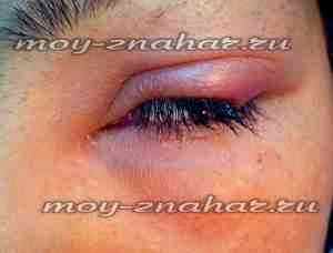 Левомицетин глазные капли и альбуцид ячмень