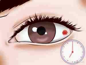 Можно ли капать альбуцид при покраснении глаз
