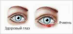 Альбуцид глазные капли от ячменя отзывы
