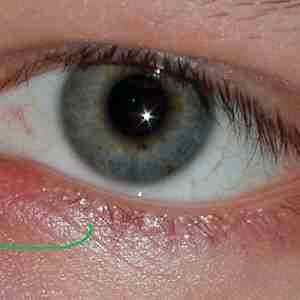 Глазные капли альбуцид при гайморите