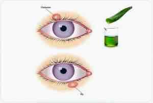 Лечение наружного ячменя на глазу альбуцид