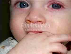 Альбуцид глазные капли для детей 4 лет