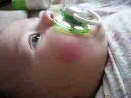 Раствор альбуцида для глаз ребенку