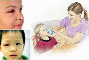 Альбуцид для детей до 3 лет