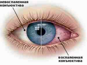 Альбуцид для глаз способ применения