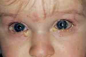 Альбуцид глазные капли маленьким детям