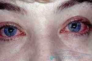Альбуцид глазные капли в нос грудничкам