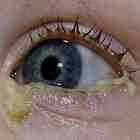 Альбуцид в глаза при аллергии