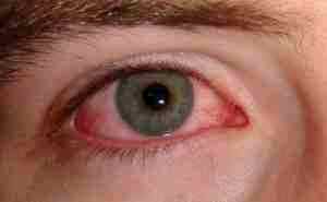 Альбуцид глазные капли при коньюктивите