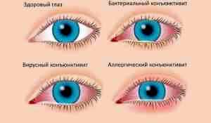 Глазные капли от коньюктивита для детей альбуцид