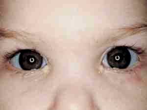 Глазные капли от коньюктивита для детей альбуцид