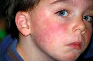 Может ли быть аллергия на альбуцид