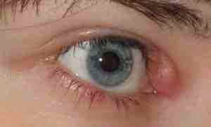 Альбуцид глазные капли для детей до 1 года