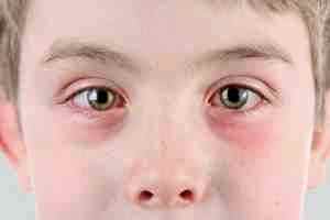 Альбуцид капли глазные инструкция по применению для детей
