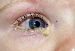 Альбуцид глазные капли для детей фото