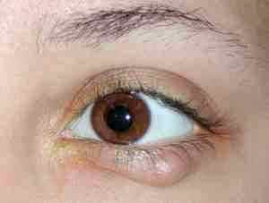 Альбуцид и сульфацил глазные капли одно и тоже