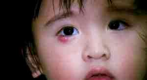 Альбуцид для лечения ячменя у детей