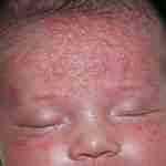 Альбуцид глазные капли для младенцев