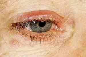 Капли для глаз левомицетин или альбуцид