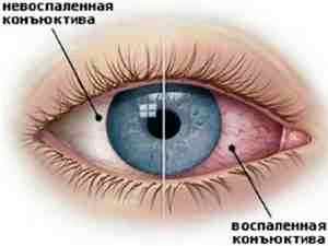 Альбуцид глазные капли для новорожденных инструкция по применению