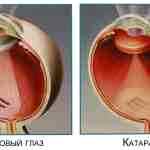 Альбуцид глазные капли инструкция при ячмене