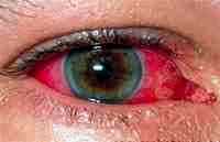 Альбуцид глазные капли это антибиотик или нет