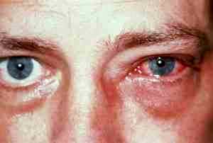 Альбуцид в глаза при жжении