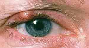 Альбуцид в глаза при жжении