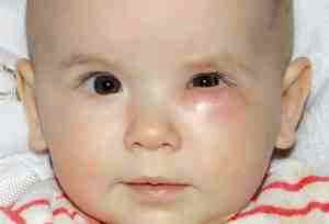 Капли альбуцид в глаза ребенку