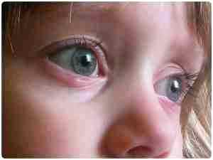 Конъюнктивит у детей лечение альбуцид