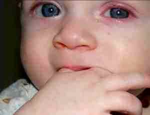 Конъюнктивит у детей лечение капли альбуцид